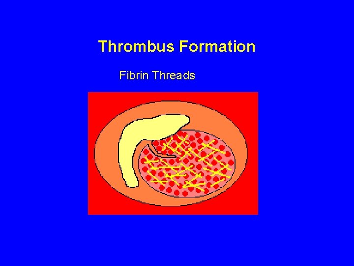 Thrombus Formation Fibrin Threads 