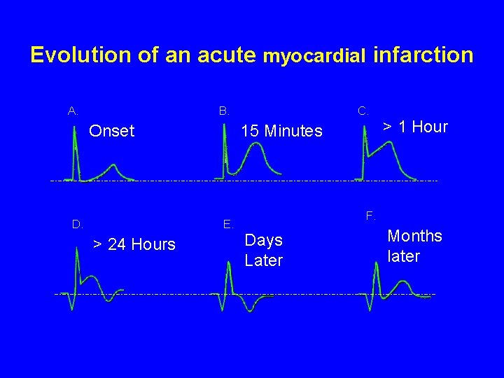 Evolution of an acute myocardial infarction A. B. Onset D. 15 Minutes E. >