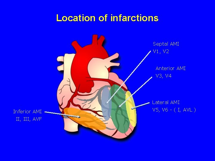 Location of infarctions Septal AMI V 1, V 2 Anterior AMI V 3, V