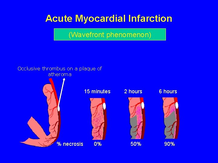 Acute Myocardial Infarction (Wavefront phenomenon) Occlusive thrombus on a plaque of atheroma 15 minutes