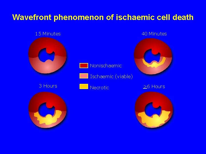 Wavefront phenomenon of ischaemic cell death 15 Minutes 40 Minutes Nonischaemic Ischaemic (viable) 3