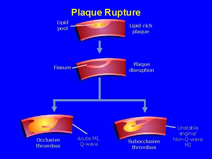 Plaque Rupture Lipid pool Lipid-rich plaque Plaque disruption Fissure Occlusive thrombus Acute MI, Q-wave