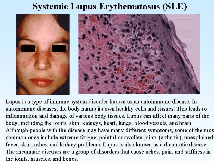 Systemic Lupus Erythematosus (SLE) Lupus is a type of immune system disorder known as