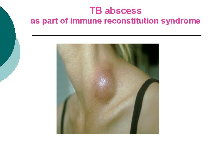 TB abscess as part of immune reconstitution syndrome 