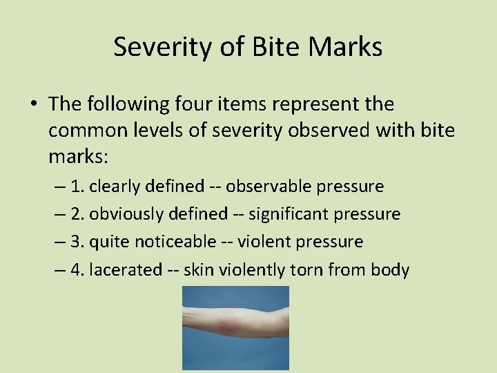 Severity of Bite Marks • The following four items represent the common levels of Severity of Bite Marks • The following four items represent the common levels of