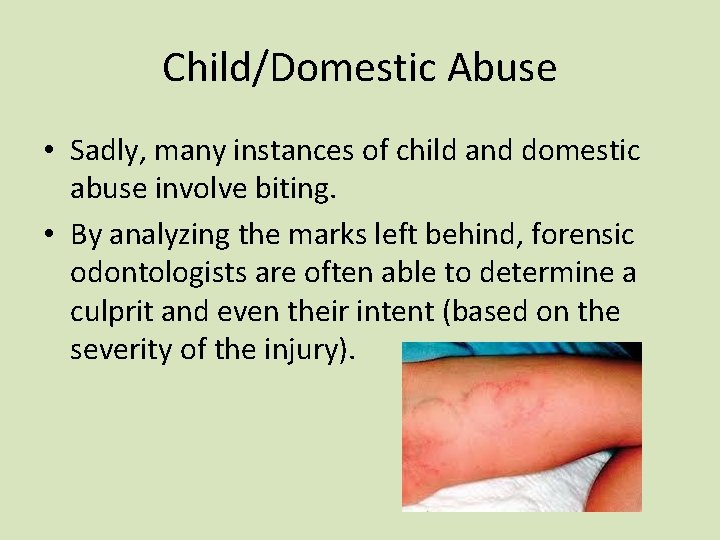 Child/Domestic Abuse • Sadly, many instances of child and domestic abuse involve biting. • Child/Domestic Abuse • Sadly, many instances of child and domestic abuse involve biting. •