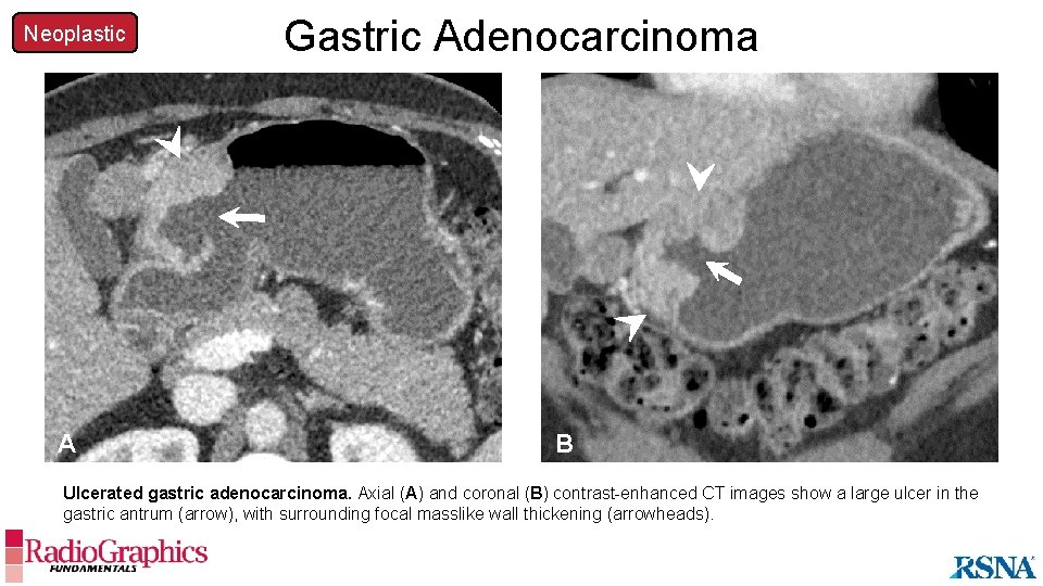 Neoplastic A Gastric Adenocarcinoma B Ulcerated gastric adenocarcinoma. Axial (A) and coronal (B) contrast-enhanced