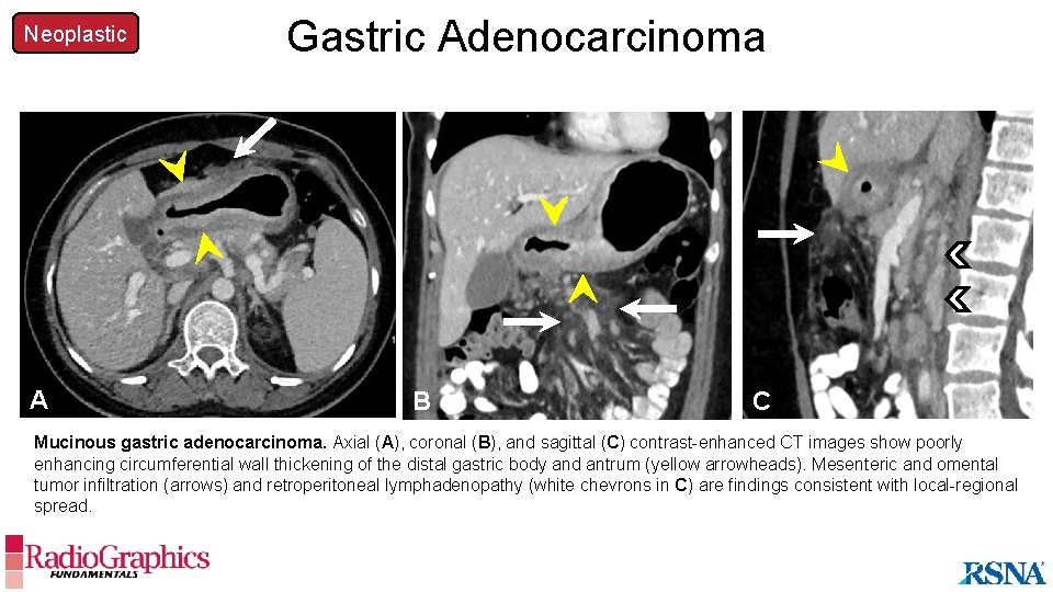 Neoplastic Gastric Adenocarcinoma A A B B C C Mucinous gastric adenocarcinoma. Axial (A),