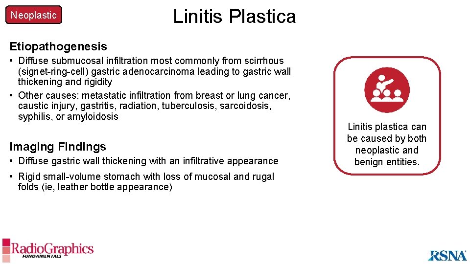 Neoplastic Linitis Plastica Etiopathogenesis • Diffuse submucosal infiltration most commonly from scirrhous (signet-ring-cell) gastric