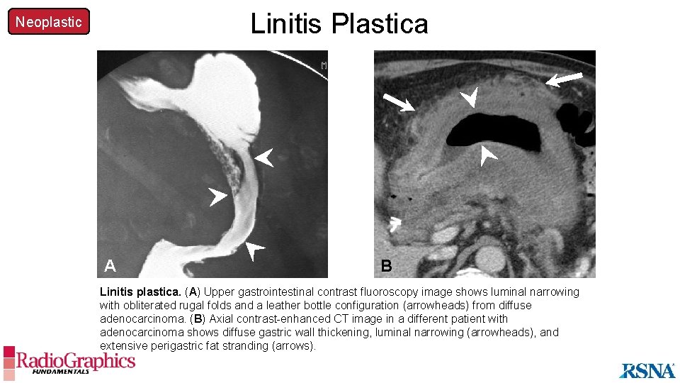 Linitis Plastica Neoplastic A B Linitis plastica. (A) Upper gastrointestinal contrast fluoroscopy image shows
