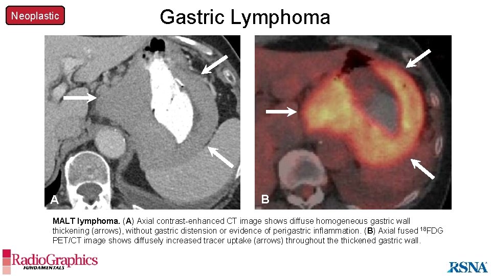 Neoplastic A Gastric Lymphoma B MALT lymphoma. (A) Axial contrast-enhanced CT image shows diffuse