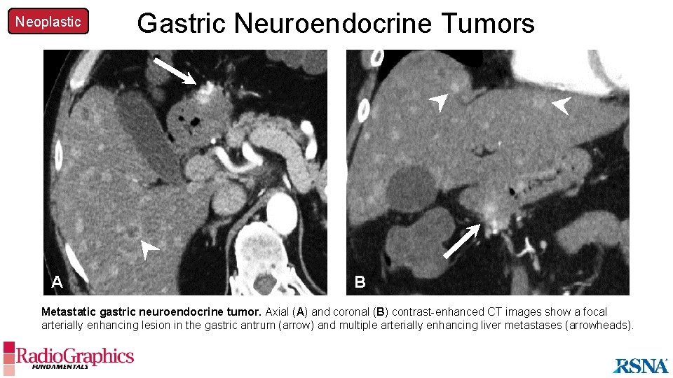 Neoplastic Gastric Neuroendocrine Tumors A A B Metastatic gastric neuroendocrine tumor. Axial (A) and