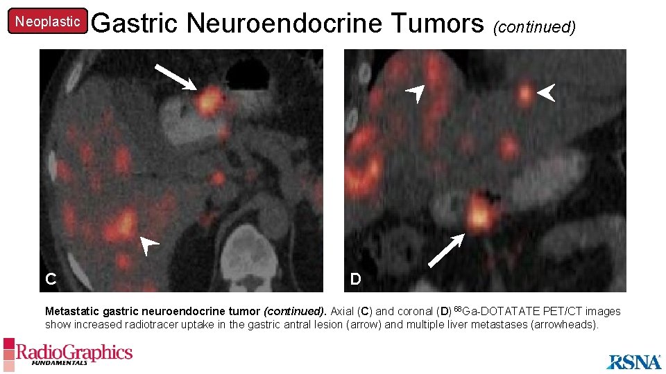 Neoplastic Gastric Neuroendocrine Tumors (continued) A C D Metastatic gastric neuroendocrine tumor (continued). Axial
