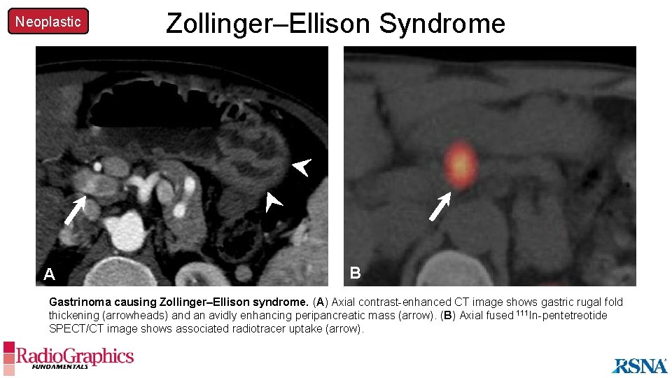 Neoplastic A Zollinger–Ellison Syndrome B Gastrinoma causing Zollinger–Ellison syndrome. (A) Axial contrast-enhanced CT image