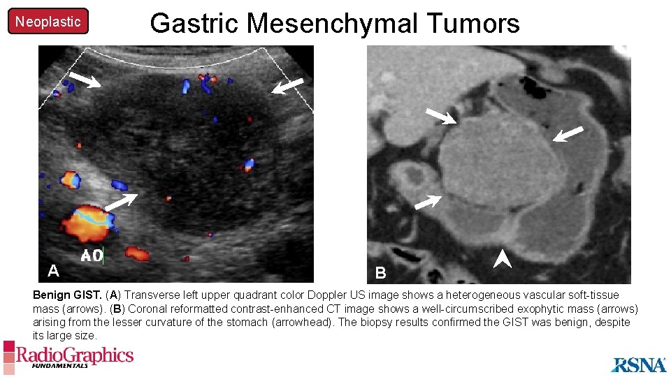 Neoplastic A Gastric Mesenchymal Tumors B Benign GIST. (A) Transverse left upper quadrant color