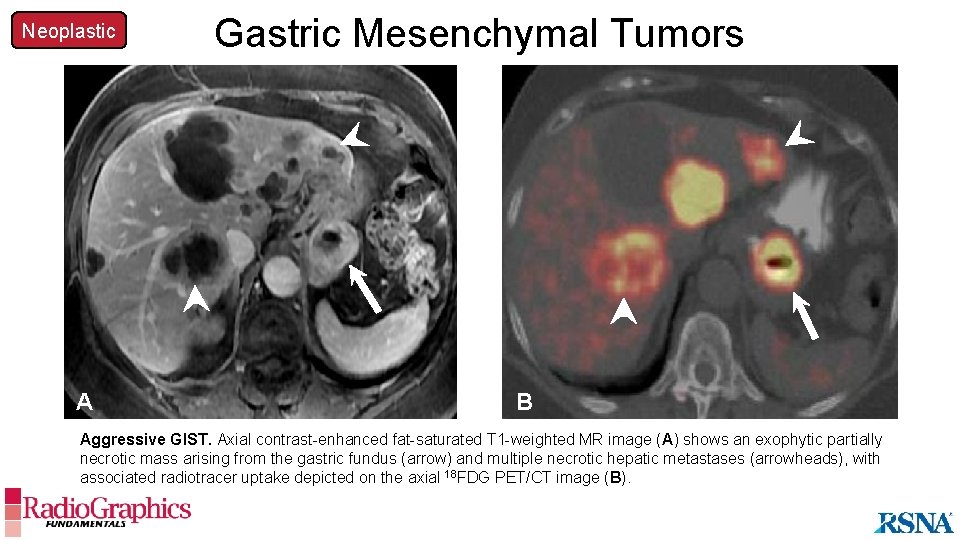 Neoplastic A Gastric Mesenchymal Tumors B Aggressive GIST. Axial contrast-enhanced fat-saturated T 1 -weighted
