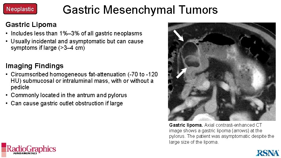 Neoplastic Gastric Mesenchymal Tumors Gastric Lipoma • Includes less than 1%– 3% of all