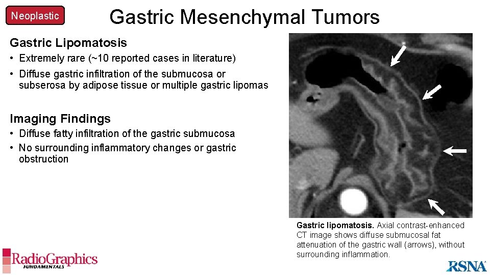 Neoplastic Gastric Mesenchymal Tumors Gastric Lipomatosis • Extremely rare (~10 reported cases in literature)