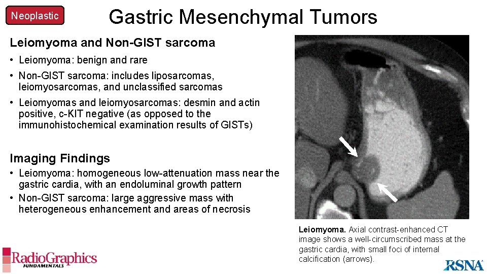 Neoplastic Gastric Mesenchymal Tumors Leiomyoma and Non-GIST sarcoma • Leiomyoma: benign and rare •