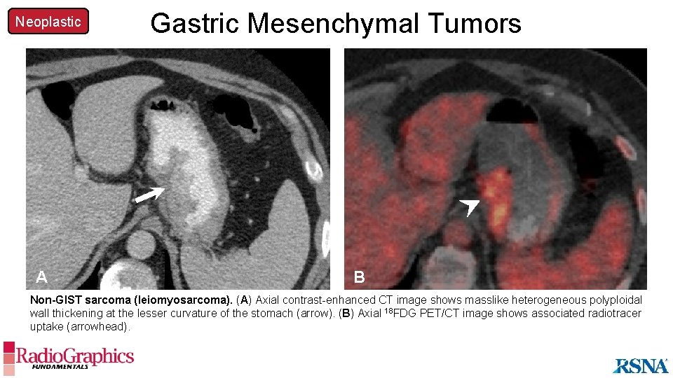 Neoplastic A Gastric Mesenchymal Tumors B Non-GIST sarcoma (leiomyosarcoma). (A) Axial contrast-enhanced CT image