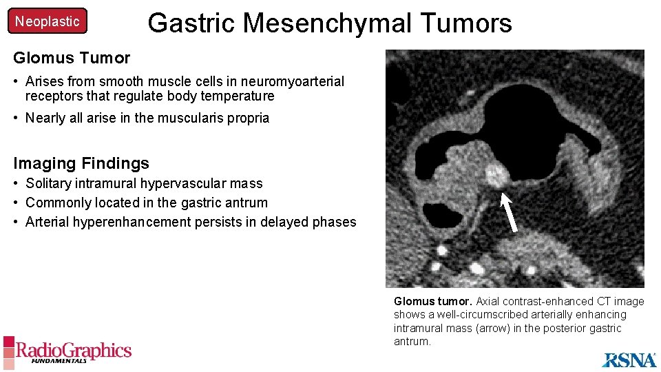 Neoplastic Gastric Mesenchymal Tumors Glomus Tumor • Arises from smooth muscle cells in neuromyoarterial