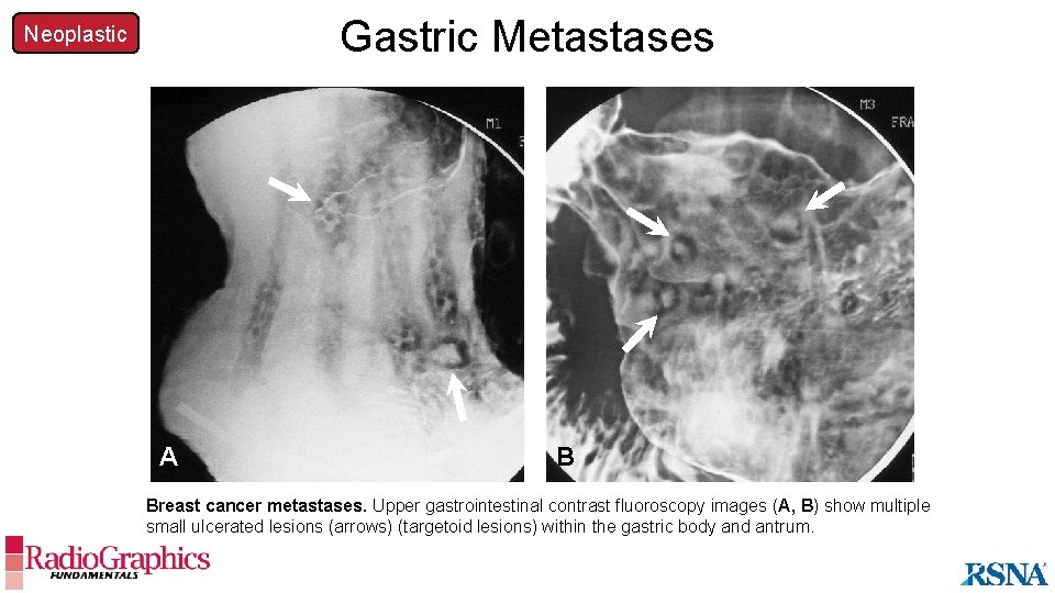 Gastric Metastases Neoplastic A B Breast cancer metastases. Upper gastrointestinal contrast fluoroscopy images (A,