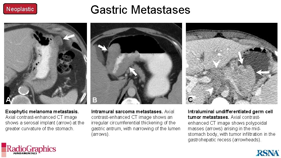 Neoplastic Gastric Metastases B A B C Exophytic melanoma metastasis. Axial contrast-enhanced CT image