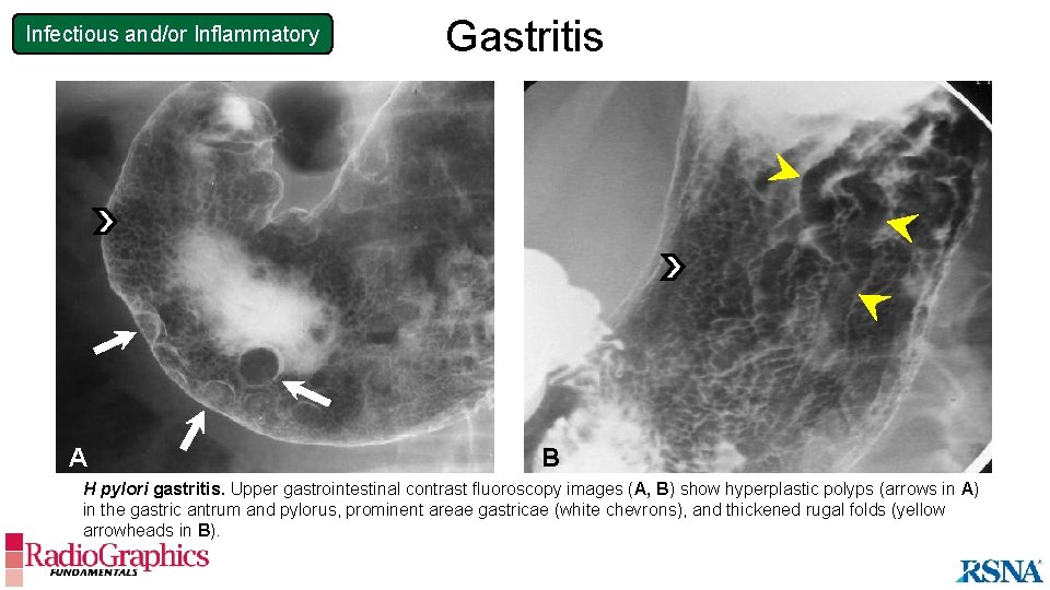 Infectious and/or Inflammatory A Gastritis B H pylori gastritis. Upper gastrointestinal contrast fluoroscopy images