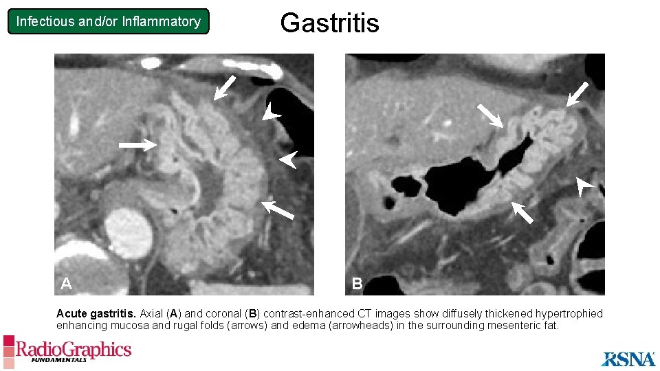 Infectious and/or Inflammatory A Gastritis B Acute gastritis. Axial (A) and coronal (B) contrast-enhanced