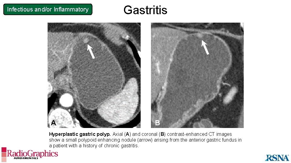 Infectious and/or Inflammatory A Gastritis B Hyperplastic gastric polyp. Axial (A) and coronal (B)