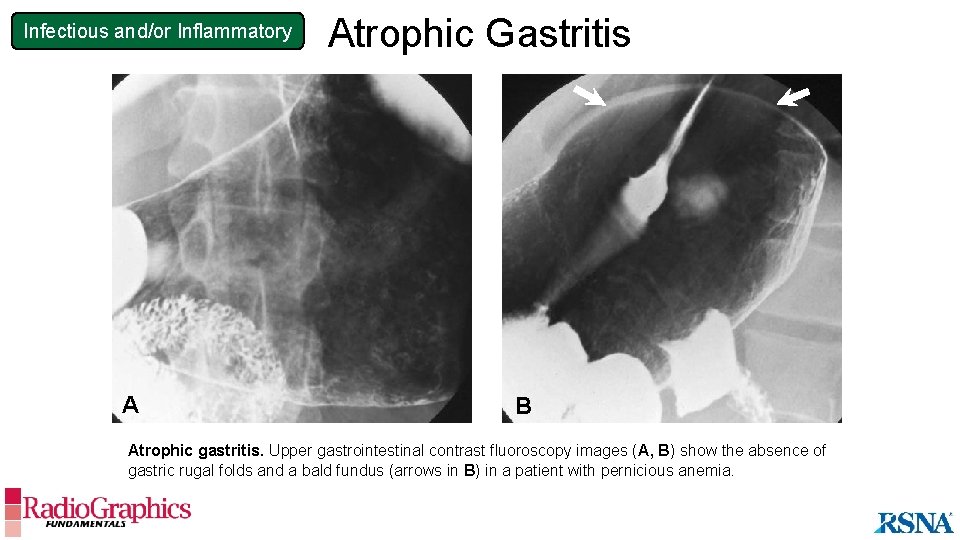 Infectious and/or Inflammatory A Atrophic Gastritis B Atrophic gastritis. Upper gastrointestinal contrast fluoroscopy images