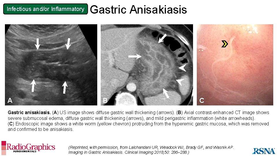 Infectious and/or Inflammatory A Gastric Anisakiasis B C Gastric anisakiasis. (A) US image shows
