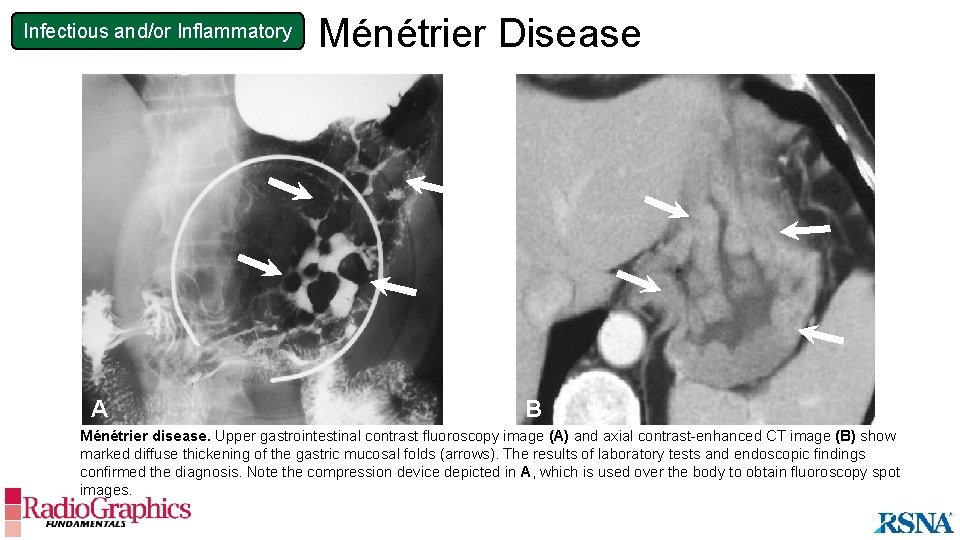 Infectious and/or Inflammatory A Ménétrier Disease B B Ménétrier disease. Upper gastrointestinal contrast fluoroscopy