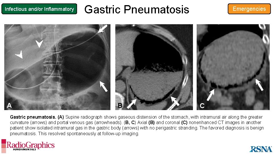 Infectious and/or Inflammatory A Gastric Pneumatosis B Emergencies C Gastric pneumatosis. (A) Supine radiograph