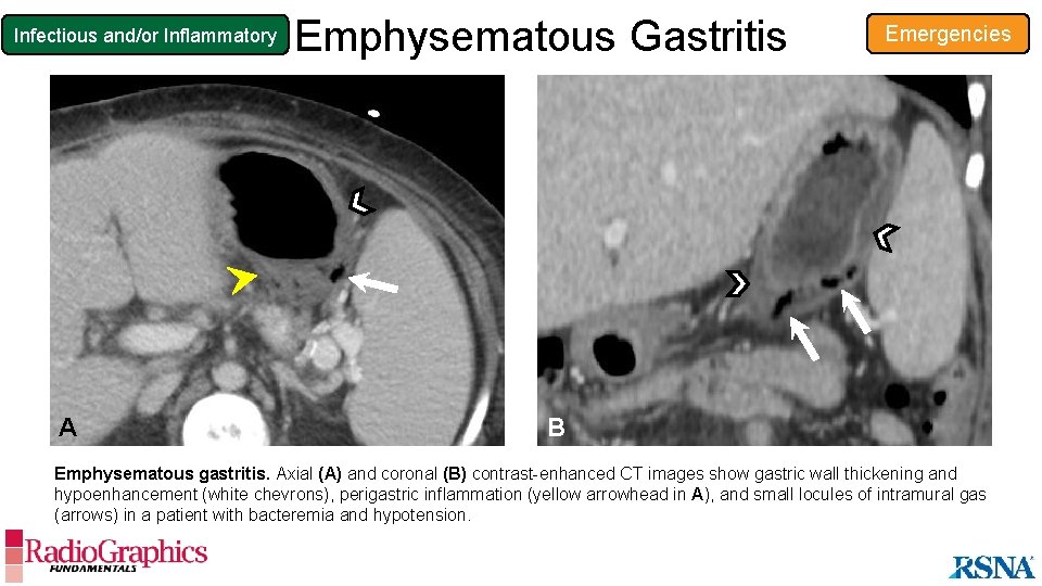 Infectious and/or Inflammatory A Emphysematous Gastritis Emergencies B Emphysematous gastritis. Axial (A) and coronal