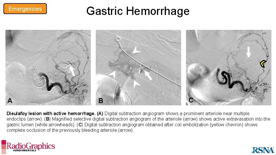 Emergencies Gastric Hemorrhage B A A B C Dieulafoy lesion with active hemorrhage. (A)