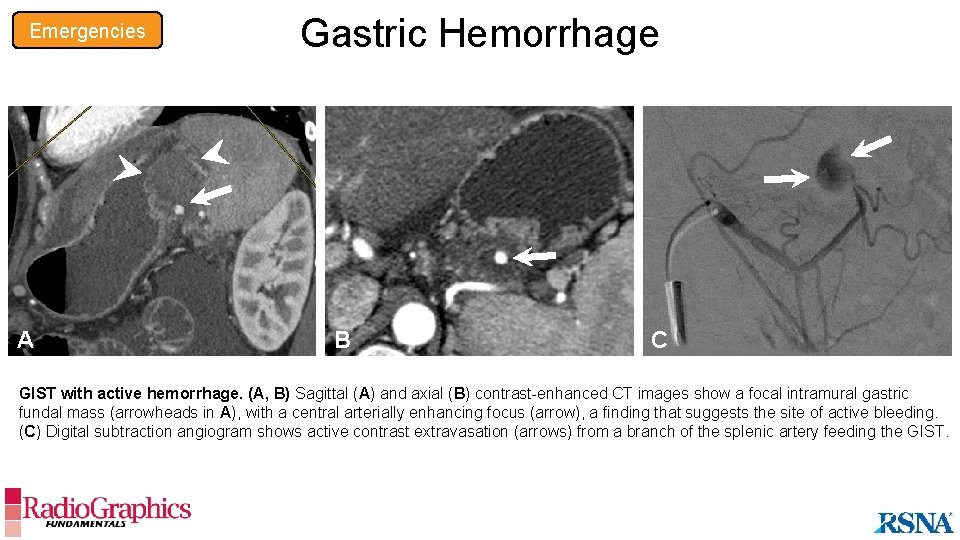 Emergencies Gastric Hemorrhage B A A B C GIST with active hemorrhage. (A, B)