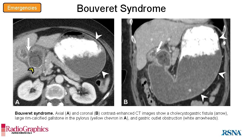Emergencies A Bouveret Syndrome B Bouveret syndrome. Axial (A) and coronal (B) contrast-enhanced CT