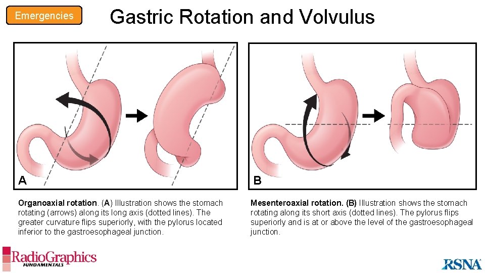 Emergencies Gastric Rotation and Volvulus A B Organoaxial rotation. (A) Illustration shows the stomach