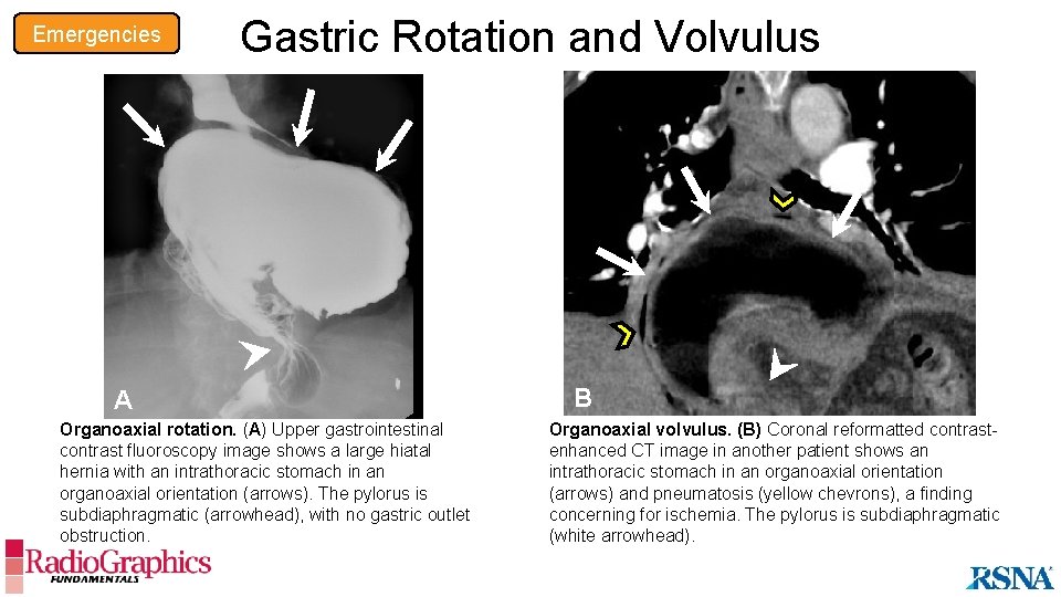 Emergencies Gastric Rotation and Volvulus A Organoaxial rotation. (A) Upper gastrointestinal contrast fluoroscopy image