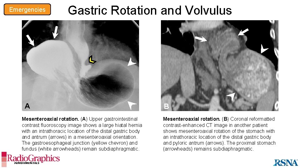 Emergencies Gastric Rotation and Volvulus A A Mesenteroaxial rotation. (A) Upper gastrointestinal contrast fluoroscopy