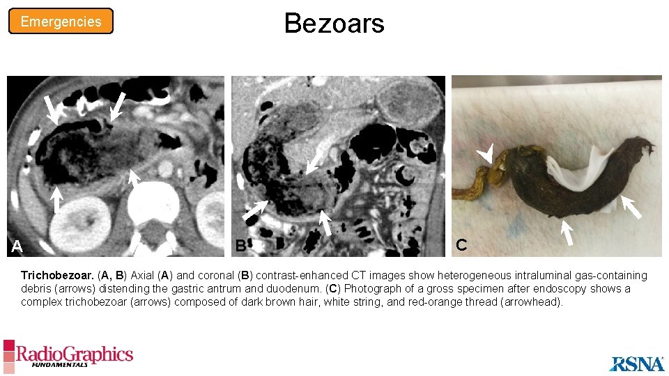 Bezoars Emergencies A B C Trichobezoar. (A, B) Axial (A) and coronal (B) contrast-enhanced