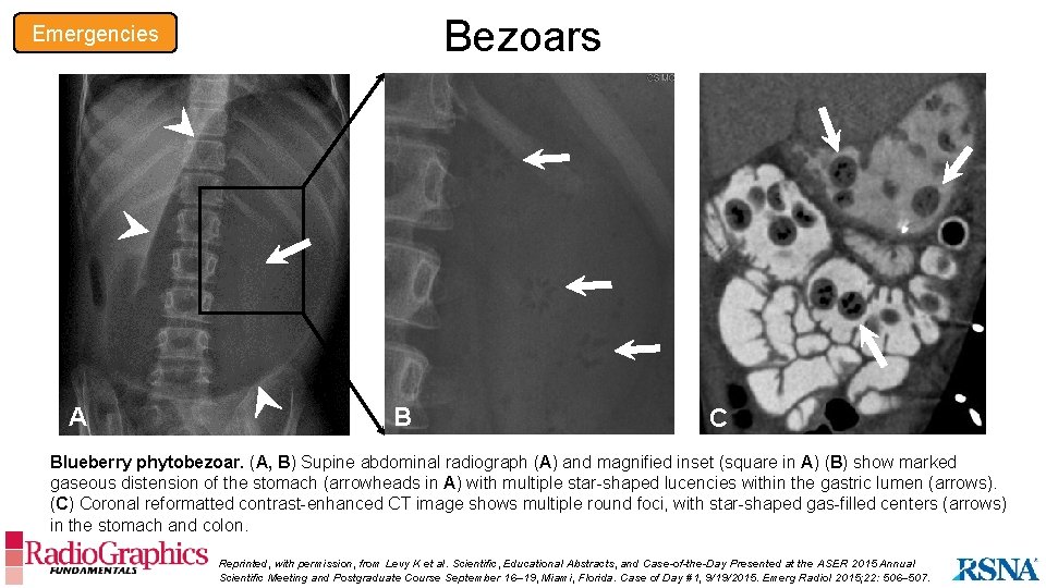 Bezoars Emergencies A B C Blueberry phytobezoar. (A, B) Supine abdominal radiograph (A) and