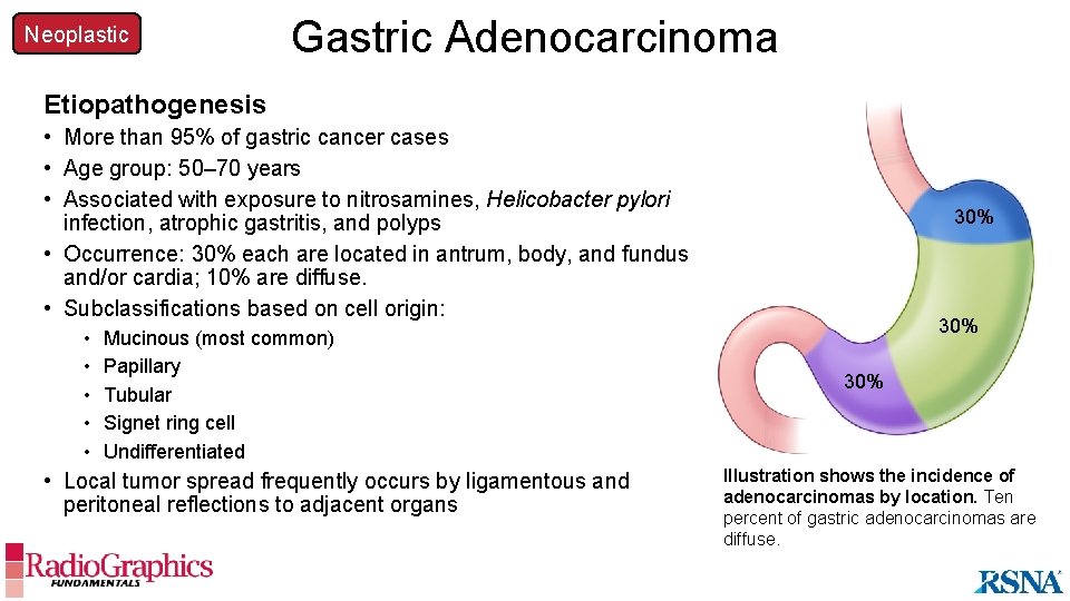 Neoplastic Gastric Adenocarcinoma Etiopathogenesis • More than 95% of gastric cancer cases • Age