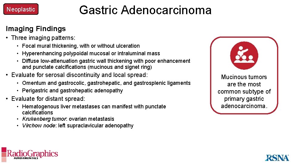 Neoplastic Gastric Adenocarcinoma Imaging Findings • Three imaging patterns: • Focal mural thickening, with
