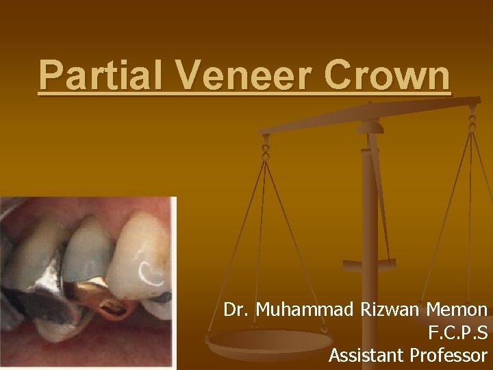 Partial Veneer Crown Dr. Muhammad Rizwan Memon F. C. P. S Assistant Professor 