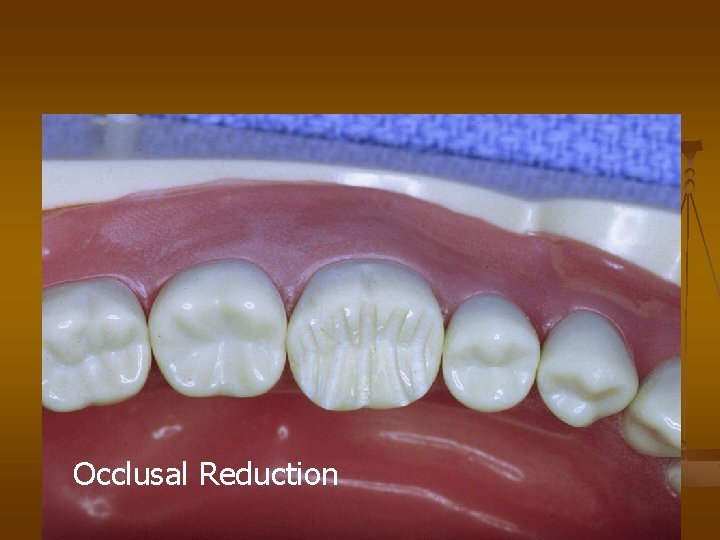 Occlusal Reduction 