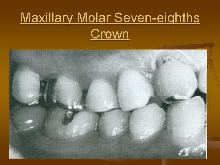 Maxillary Molar Seven-eighths Crown 