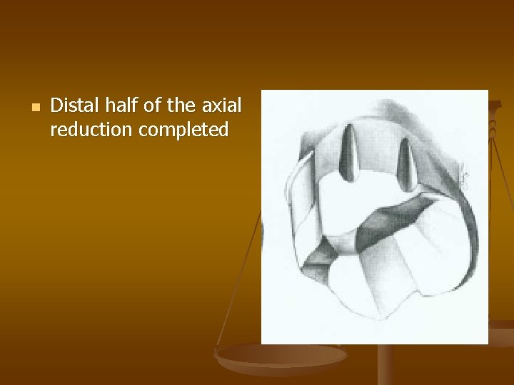 n Distal half of the axial reduction completed 