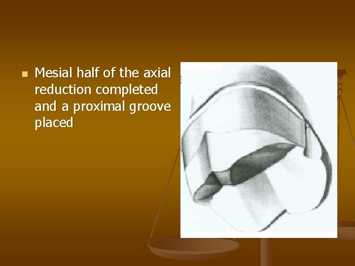 n Mesial half of the axial reduction completed and a proximal groove placed 
